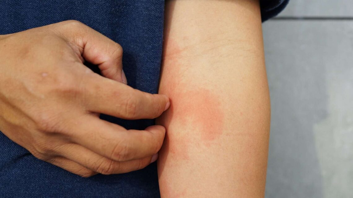 Managing Eczema: The Best Ways To Deal With Eczema Flares and Keep Your Skin Healthy and Comfortable