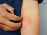 Managing Eczema: The Best Ways To Deal With Eczema Flares and Keep Your Skin Healthy and Comfortable